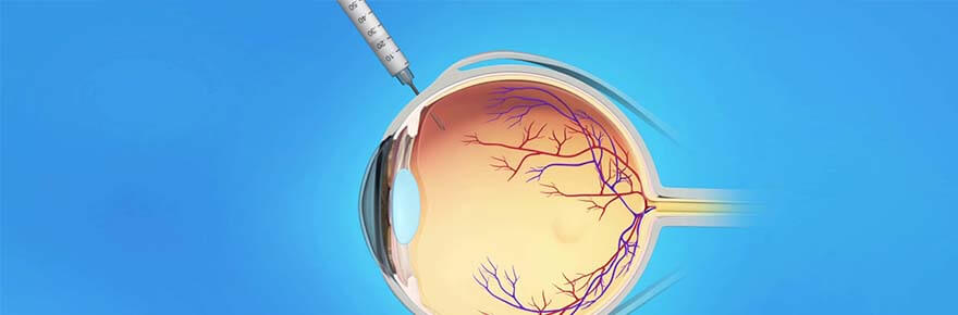 pagina injecao intravitrea