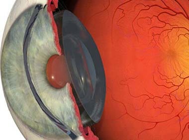 retinea e vitreo hospital de olhos de goiania